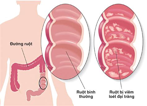 Phẫu thuật viêm loét đại tràng: Những điều cần biết | Vinmec