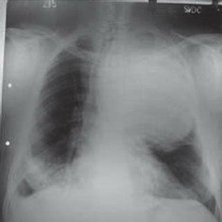 Chest Radiograph Postero Anterior View Showing A Homogeneous