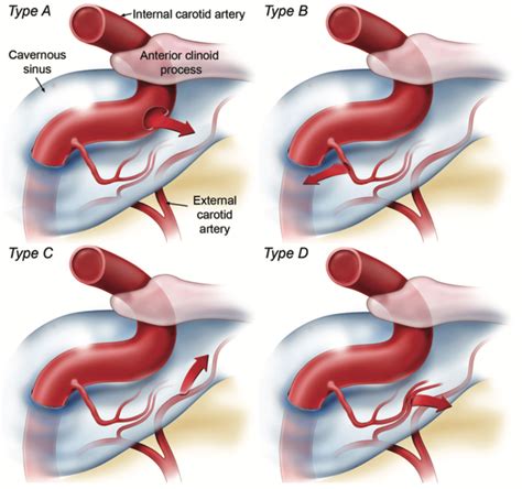 Cavernous Sinus Internal Carotid Artery