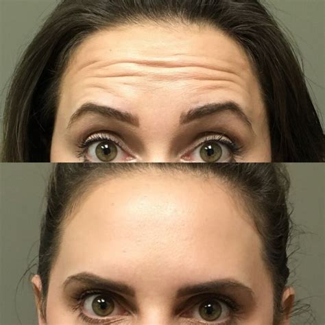 Botox Antes E Depois Botox Aesthetic Medicine Plastic Surgery