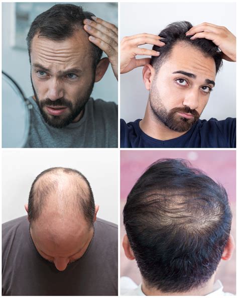 Best Hair Transplant In Delhi — Embark On Your Hair Transformation