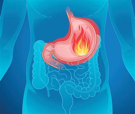 Rimedi Per Il Bruciore Di Stomaco Come Farlo Passare E Cosa Prendere