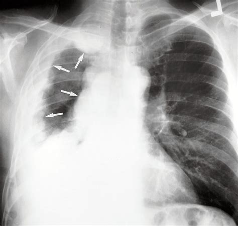 Pleura Chest Wall And Diaphragm Radiology Key