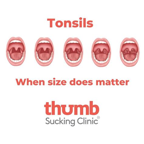 TONSILS - when size DOES matter. Many people, including health ...