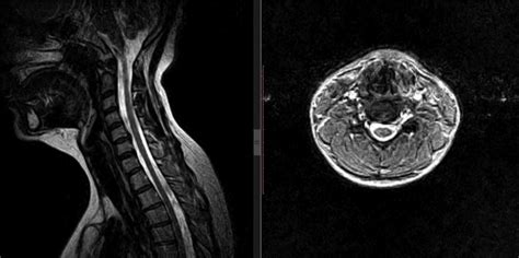 Preoperative MRI demonstrating herniated disc at C5-6. | Download Scientific Diagram