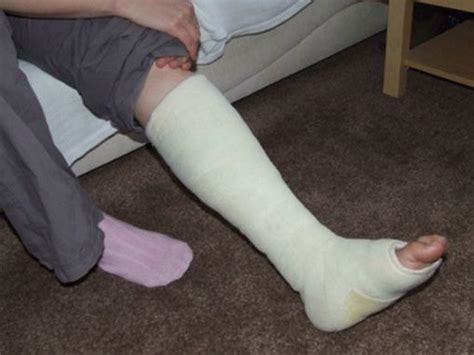 Leg Cast Foot