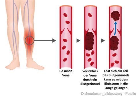 Thrombose Symptome Behandlung Ursachen Vorbeugung Netdoktor