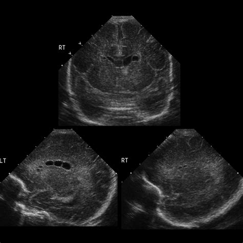 Connatal Cyst Pediatric Radiology Reference Article Pediatric Imaging Pedsimaging