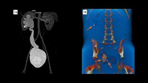 Pediatric Ureterocele Complicated By Urolithiasis Siemens