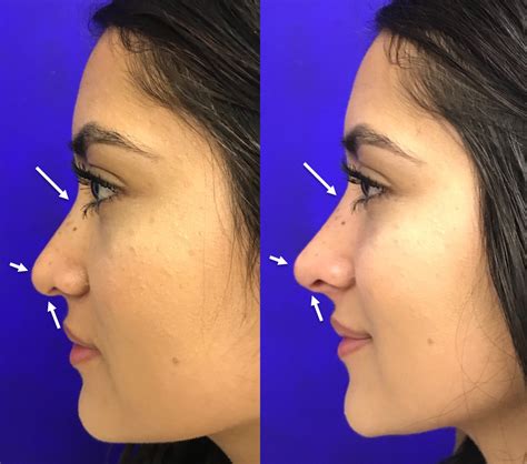 Liquid Rhinoplasty For Non Surgical Nose Jobs In Santa Rosa