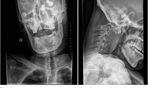 Figure 1 From A Case Report Of Complete Dislocation Of Atlantoaxial