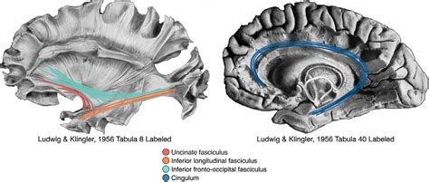 Uncinate Fasciculus Anatomy