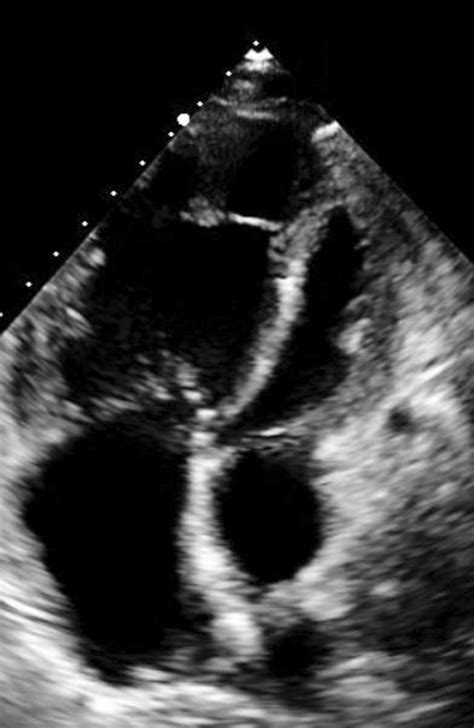 Transthoracic Echocardiogram Apical Four‐chamber View Demonstrating