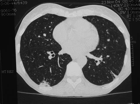 Arthritis Nodules On Lungs