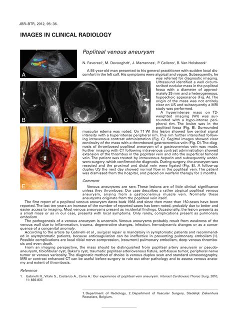 PDF Popliteal Venous Aneurysm