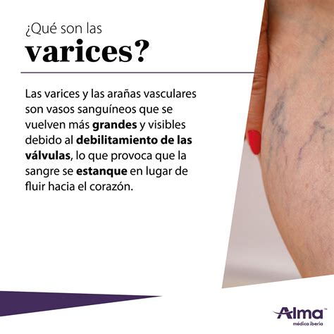 La Aparición De Arañas Vasculares O Alma Lasers Médica