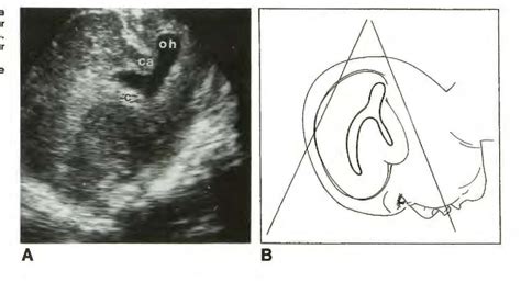 Figure 1 From Technical Note Sonography Through The Posterior