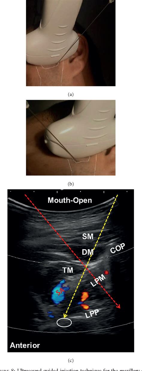 Figure From Ultrasound Guided Intervention For Treatment Of