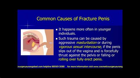 Penis Fracture Reconstructive Plastic Surgery Repair With Good