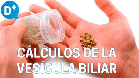 Causas y síntomas de los cálculos de la vesícula biliar YouTube