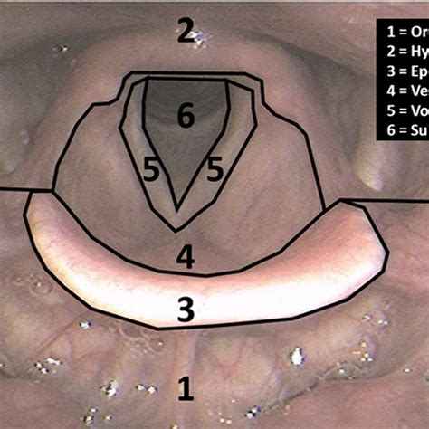 Anatomic boundary for the laryngeal vestibule | Download Scientific Diagram