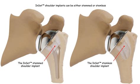 Total Shoulder Replacement Surgery Shoulder Innovations