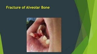 Complications of tooth extraction | PPT