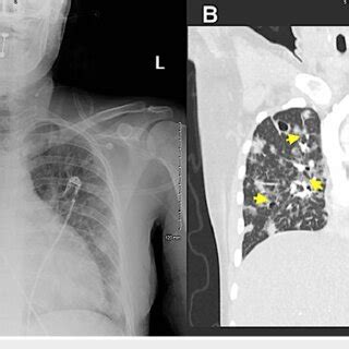 Portable Chest Radiography Demonstrating Mild Cardiomegaly And