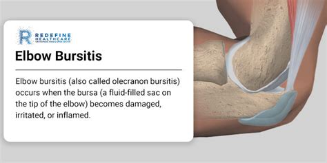 Qu Es La Bursa Todo Sobre La Bursitis Y C Mo Prevenirla