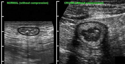 Crohn's Disease Ultrasound