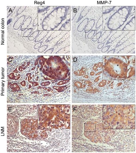 Expression Of Reg4 And MMP 7 In Normal Cancer And Lymph Node Tissues