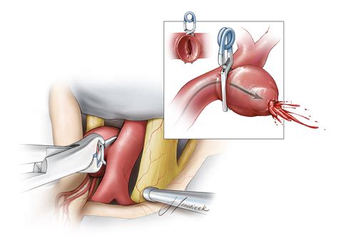 Brain Aneurysm Expert Surgeon Aaron Cohen Gadol MD