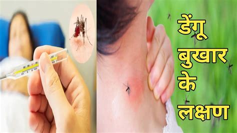 डेंगू बुखार के लक्षण कारण घरेलू उपचार और परहेज Home Remedies For Dengue Fever Dengue