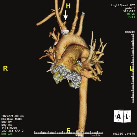 Digital Subtraction Angiogram Of The Innominate Artery For Stent Graft