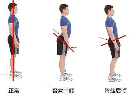骨盆前倾危害大不如试试这个3个小动作帮你缓解 凤凰网