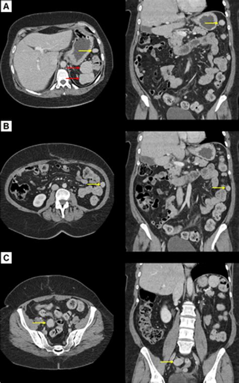 Figure From Abdominal Splenosis Mimicking Peritoneal Carcinomatosis