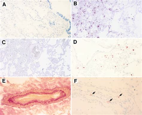 Mast Cell Chymase In Pulmonary Hypertension Thorax