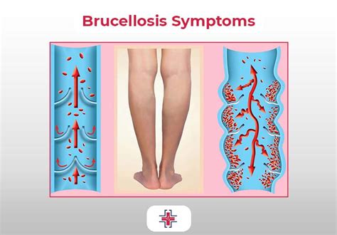 A Comprehensive Guide To Brucellosis Causes Symptoms And Treatments Er Of Mesquite