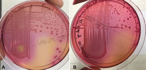 Mutations Of CysB In Urinary Isolates Of Cysteine Requiring Escherichia