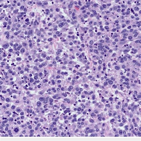 High Grade Uterine Sarcoma High Grade Endometrial Stromal Sarcoma Hg