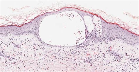 Differential Diagnosis In Dermatopathology Collections Of Cells In The