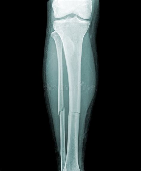 Complete Fracture Of The Lower Leg Stock Illustration Image 13362448