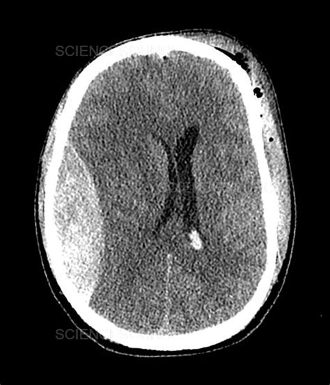 Epidural Hematoma On Ct Stock Image Science Source Images