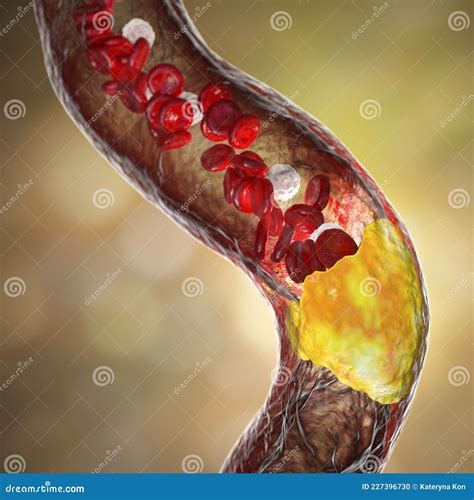 Atherosclerosis Atheromatous Plaque Inside Artery Stock Illustration