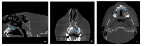 The Sag Tal A Coronal B And Axial C Slices Of Cbct Show An Impacted