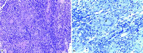 A Granuloma With Langhans Giant Cells Arrow Hande ×20 B Acid Fast