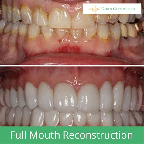 Full Mouth Reconstruction Smiles By Glerum