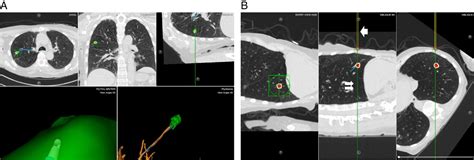 Peripheral Lung Nodule Diagnosis And Fiducial Marker Placeme Journal Of Bronchology