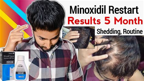 Minoxidil Restart Month Results Routine Shedding Youtube