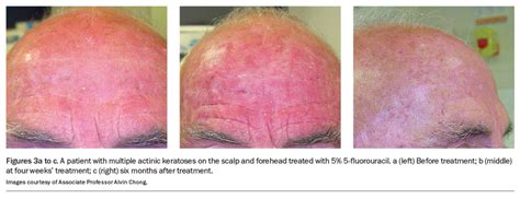 Actinic Keratosis An Update On Management Medicine Today